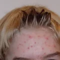10 Ways How To Cure Acne Naturally 4 10 Ways How To Cure Acne Naturally