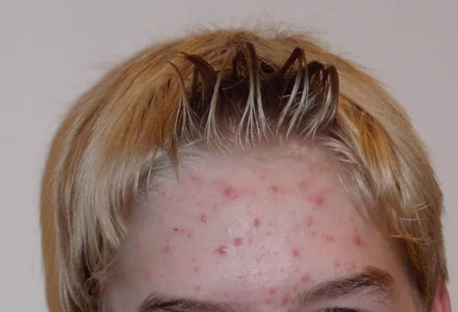 10 Ways How To Cure Acne Naturally 1 10 Ways How To Cure Acne Naturally