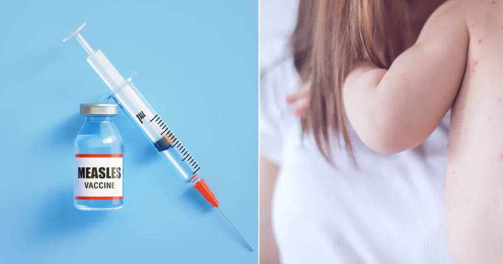 Singapore Preschool Confirms First Measles Case Since New Measures
