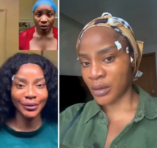 Actress Uche Ogbodo Shares Day One Update After Facial Lift Procedure